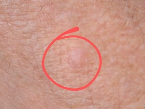 Skin-lesion